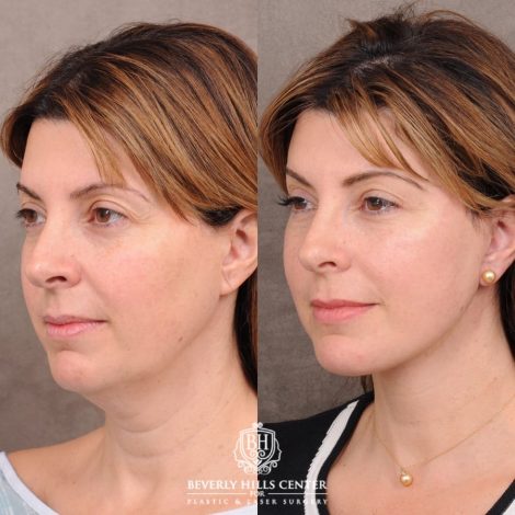 Beverly Hills Center Female Patient Before and After AuraLyft, Upper Blepharoplasty, Fat Grafting