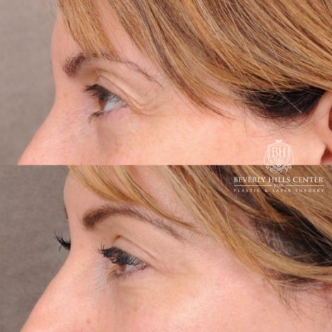 Beverly Hills Center Female Patient Before and After AuraLyft, Upper Blepharoplasty, Fat Grafting