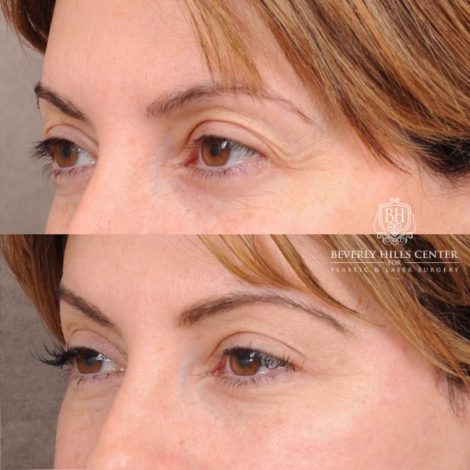 Beverly Hills Center Female Patient Before and After AuraLyft, Upper Blepharoplasty, Fat Grafting