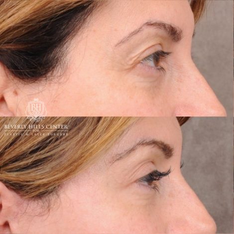 Beverly Hills Center Female Patient Before and After AuraLyft, Upper Blepharoplasty, Fat Grafting
