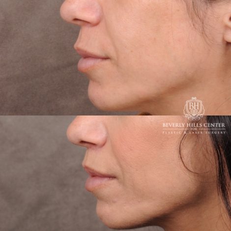 Beverly Hills Center Female Patient Before and After CUPID LIFT® Lip Lift