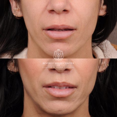 Beverly Hills Center Female Patient Before and After CUPID LIFT® Lip Lift