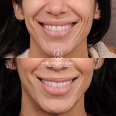 Beverly Hills Center Female Patient Before and After CUPID LIFT® Lip Lift