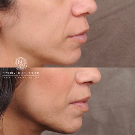 Beverly Hills Center Female Patient Before and After CUPID LIFT® Lip Lift
