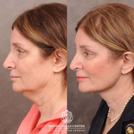 Beverly Hills Center Female Patient Before and After AuraLyft, Upper Blepharoplasty, Temporal Brow Reset, and Ptosis Repair