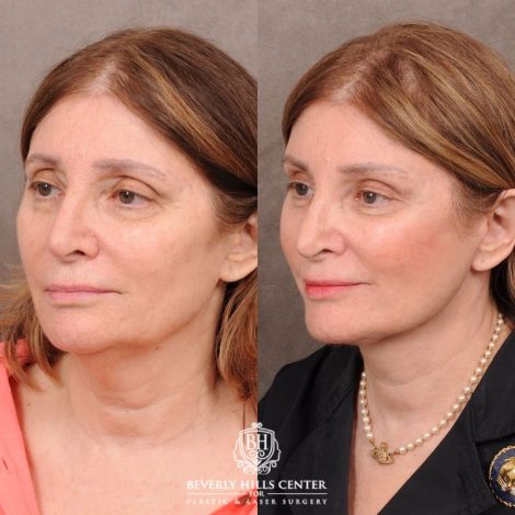 Beverly Hills Center Female Patient Before and After AuraLyft, Upper Blepharoplasty, Temporal Brow Reset, and Ptosis Repair