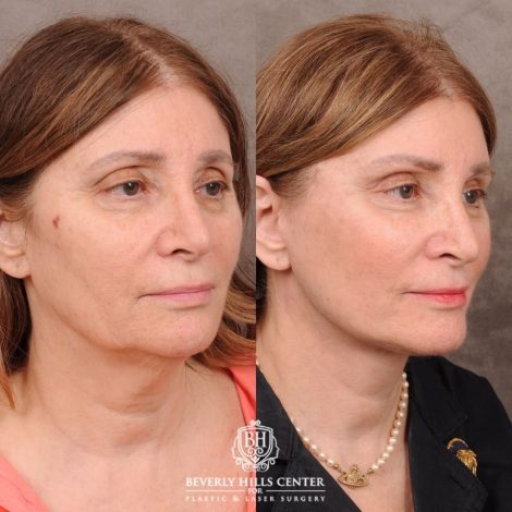 Beverly Hills Center Female Patient Before and After AuraLyft, Upper Blepharoplasty, Temporal Brow Reset, and Ptosis Repair