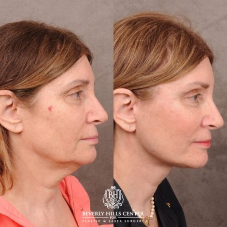 Beverly Hills Center Female Patient Before and After AuraLyft, Upper Blepharoplasty, Temporal Brow Reset, and Ptosis Repair