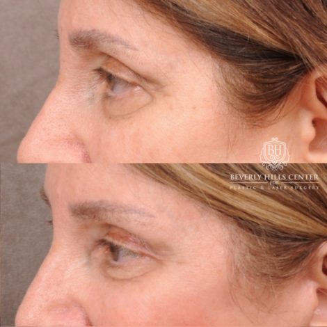 Beverly Hills Center Female Patient Before and After AuraLyft, Upper Blepharoplasty, Temporal Brow Reset, and Ptosis Repair