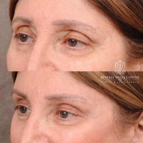 Beverly Hills Center Female Patient Before and After AuraLyft, Upper Blepharoplasty, Temporal Brow Reset, and Ptosis Repair