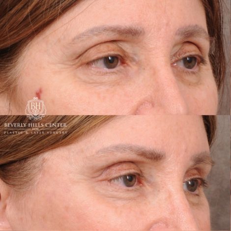 Beverly Hills Center Female Patient Before and After AuraLyft, Upper Blepharoplasty, Temporal Brow Reset, and Ptosis Repair