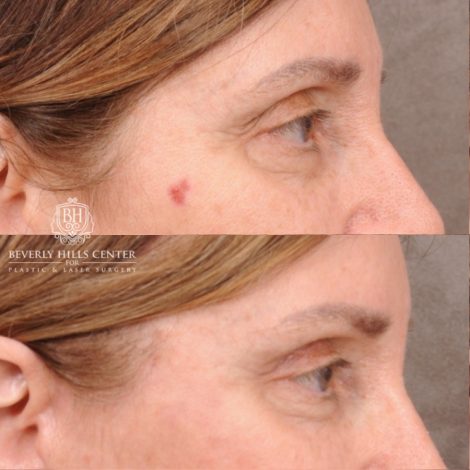 Beverly Hills Center Female Patient Before and After AuraLyft, Upper Blepharoplasty, Temporal Brow Reset, and Ptosis Repair