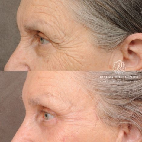 Beverly Hills Center Female Patient Before and After AuraLuft, Brow Lift, Upper Blepharoplasty, CUPID LIFT® Corner Lift, Fat Grafting & Ptosis Repair