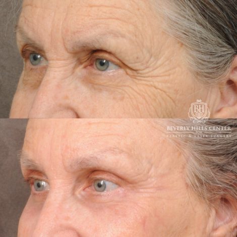 Beverly Hills Center Female Patient Before and After AuraLuft, Brow Lift, Upper Blepharoplasty, CUPID LIFT® Corner Lift, Fat Grafting & Ptosis Repair