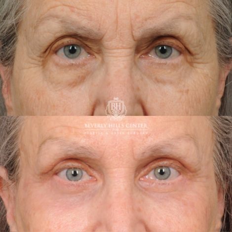 Beverly Hills Center Female Patient Before and After AuraLuft, Brow Lift, Upper Blepharoplasty, CUPID LIFT® Corner Lift, Fat Grafting & Ptosis Repair
