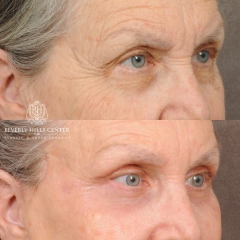 Beverly Hills Center Female Patient Before and After AuraLuft, Brow Lift, Upper Blepharoplasty, CUPID LIFT® Corner Lift, Fat Grafting & Ptosis Repair