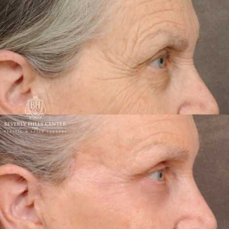 Beverly Hills Center Female Patient Before and After AuraLuft, Brow Lift, Upper Blepharoplasty, CUPID LIFT® Corner Lift, Fat Grafting & Ptosis Repair