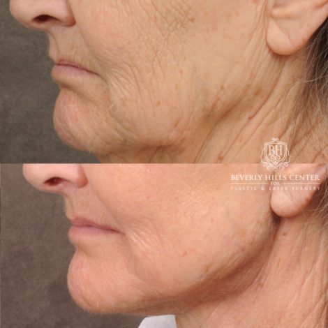 Beverly Hills Center Female Patient Before and After AuraLuft, Brow Lift, Upper Blepharoplasty, CUPID LIFT® Corner Lift, Fat Grafting & Ptosis Repair