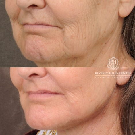 Beverly Hills Center Female Patient Before and After AuraLuft, Brow Lift, Upper Blepharoplasty, CUPID LIFT® Corner Lift, Fat Grafting & Ptosis Repair