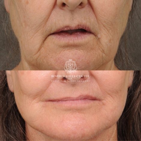 Beverly Hills Center Female Patient Before and After AuraLuft, Brow Lift, Upper Blepharoplasty, CUPID LIFT® Corner Lift, Fat Grafting & Ptosis Repair