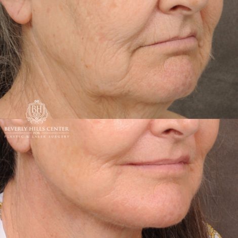 Beverly Hills Center Female Patient Before and After AuraLuft, Brow Lift, Upper Blepharoplasty, CUPID LIFT® Corner Lift, Fat Grafting & Ptosis Repair