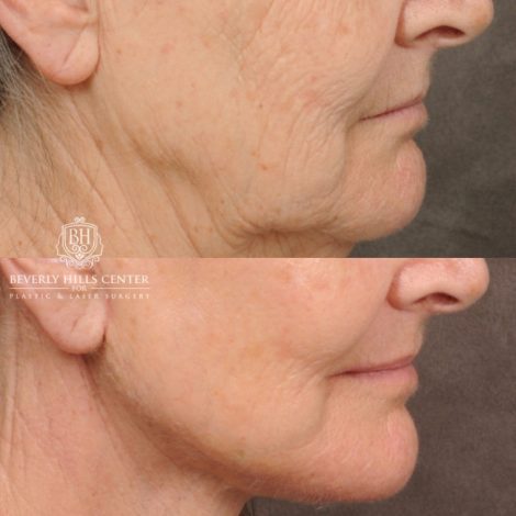 Beverly Hills Center Female Patient Before and After AuraLuft, Brow Lift, Upper Blepharoplasty, CUPID LIFT® Corner Lift, Fat Grafting & Ptosis Repair