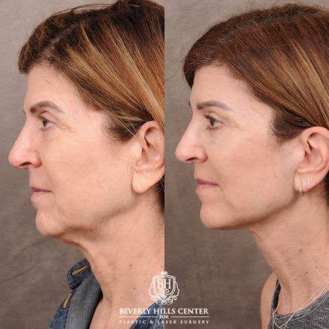 Beverly Hills Center Female Patient Before and After AuraLyft™, CUPID LIFT® Lip Lift, Upper Blepharoplasty with Ptosis Repair