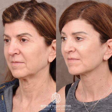 Beverly Hills Center Female Patient Before and After AuraLyft™, CUPID LIFT® Lip Lift, Upper Blepharoplasty with Ptosis Repair