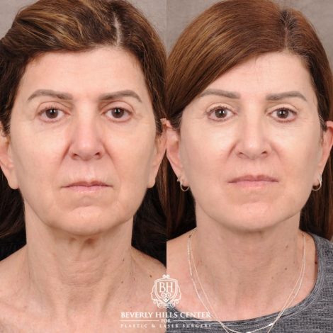 Beverly Hills Center Female Patient Before and After AuraLyft™, CUPID LIFT® Lip Lift, Upper Blepharoplasty with Ptosis Repair