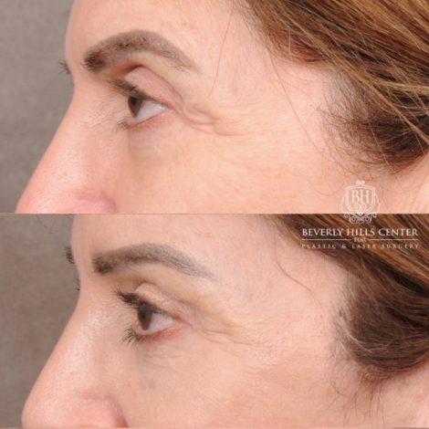 Beverly Hills Center Female Patient Before and After AuraLyft™, CUPID LIFT® Lip Lift, Upper Blepharoplasty with Ptosis Repair