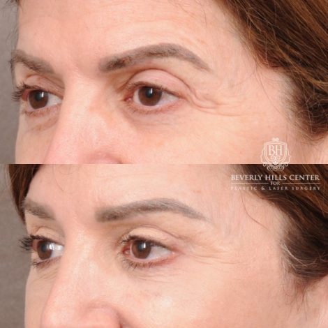 Beverly Hills Center Female Patient Before and After AuraLyft™, CUPID LIFT® Lip Lift, Upper Blepharoplasty with Ptosis Repair