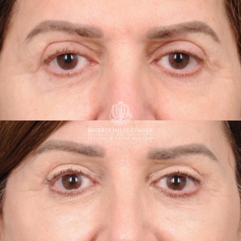Beverly Hills Center Female Patient Before and After AuraLyft™, CUPID LIFT® Lip Lift, Upper Blepharoplasty with Ptosis Repair
