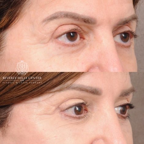 Beverly Hills Center Female Patient Before and After AuraLyft™, CUPID LIFT® Lip Lift, Upper Blepharoplasty with Ptosis Repair