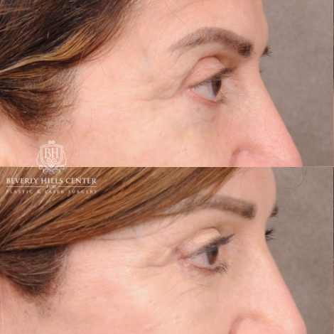 Beverly Hills Center Female Patient Before and After AuraLyft™, CUPID LIFT® Lip Lift, Upper Blepharoplasty with Ptosis Repair
