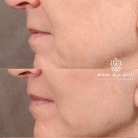 Beverly Hills Center Female Patient Before and After AuraLyft™, CUPID LIFT® Lip Lift, Upper Blepharoplasty with Ptosis Repair