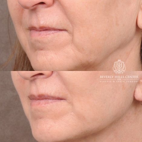 Beverly Hills Center Female Patient Before and After AuraLyft™, CUPID LIFT® Lip Lift, Upper Blepharoplasty with Ptosis Repair