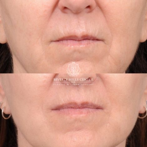 Beverly Hills Center Female Patient Before and After AuraLyft™, CUPID LIFT® Lip Lift, Upper Blepharoplasty with Ptosis Repair