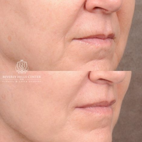 Beverly Hills Center Female Patient Before and After AuraLyft™, CUPID LIFT® Lip Lift, Upper Blepharoplasty with Ptosis Repair