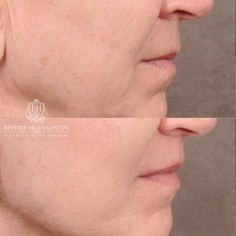 Beverly Hills Center Female Patient Before and After AuraLyft™, CUPID LIFT® Lip Lift, Upper Blepharoplasty with Ptosis Repair