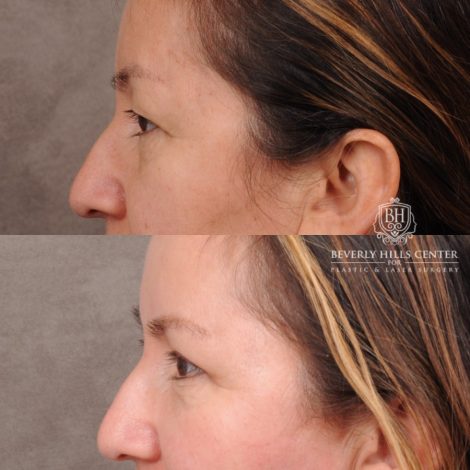 Beverly Hills Center Female Patient Before and After Temporal Brow Reset, Upper Blepharoplasty