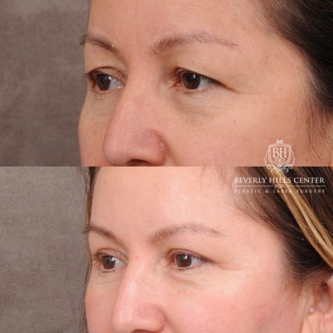 Beverly Hills Center Female Patient Before and After Temporal Brow Reset, Upper Blepharoplasty