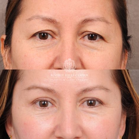 Beverly Hills Center Female Patient Before and After Temporal Brow Reset, Upper Blepharoplasty