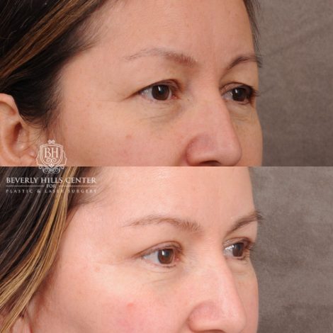 Beverly Hills Center Female Patient Before and After Temporal Brow Reset, Upper Blepharoplasty