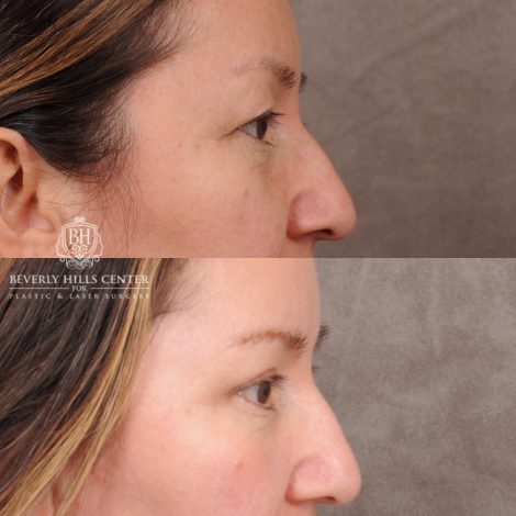 Beverly Hills Center Female Patient Before and After Temporal Brow Reset, Upper Blepharoplasty