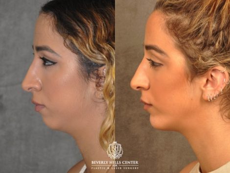 Beverly Hills Center Female Patient Before and After Weekend Necklift