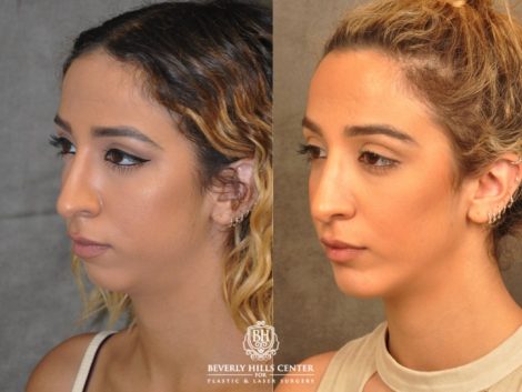 Beverly Hills Center Female Patient Before and After Weekend Necklift