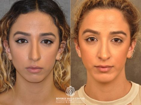 Beverly Hills Center Female Patient Before and After Weekend Necklift