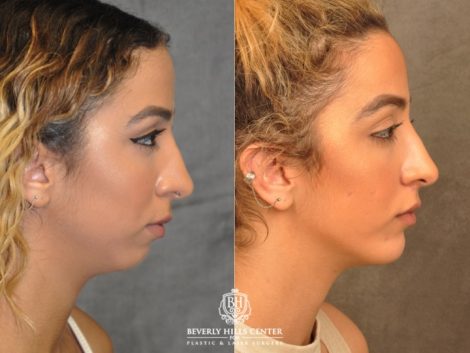 Beverly Hills Center Female Patient Before and After Weekend Necklift