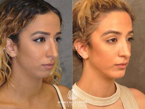Beverly Hills Center Female Patient Before and After Weekend Necklift