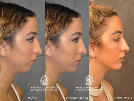 Beverly Hills Center Female Patient Before and After Weekend Necklift